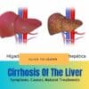 Cirrhosis Of The Liver